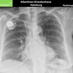 Transparenzminderung - DocCheck Flexikon