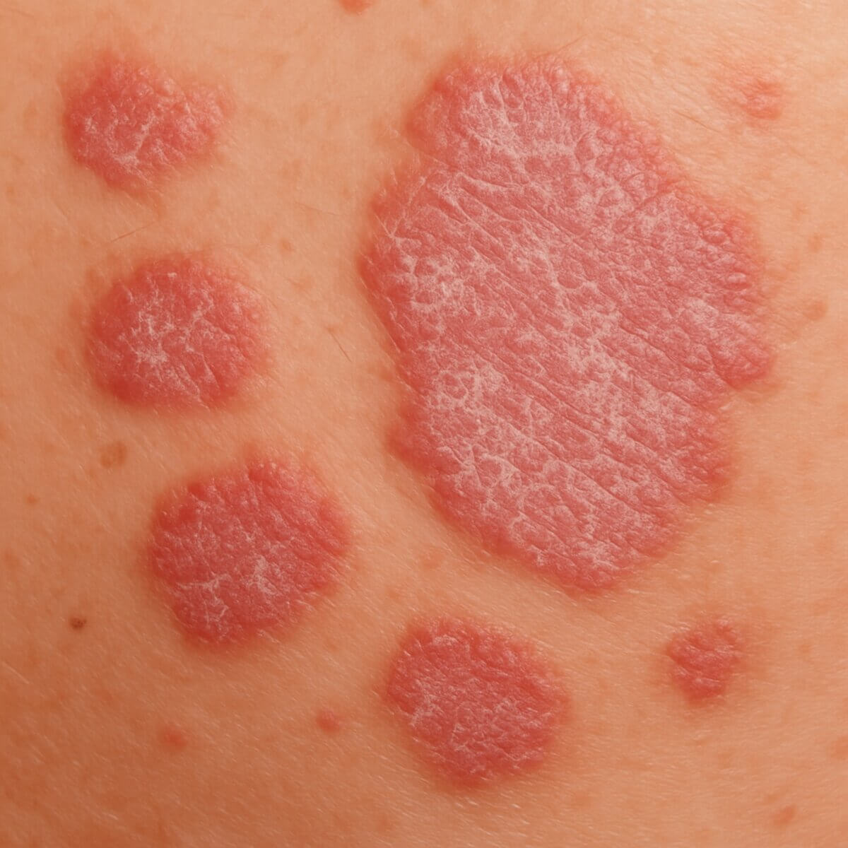 Nummuläre Psoriasisherde