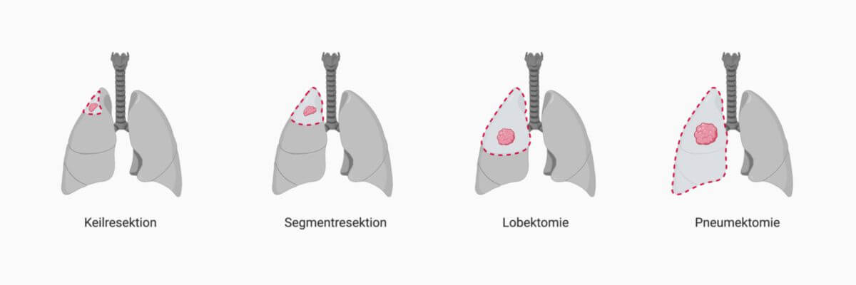 Operationsmethoden bei Lungenkrebs