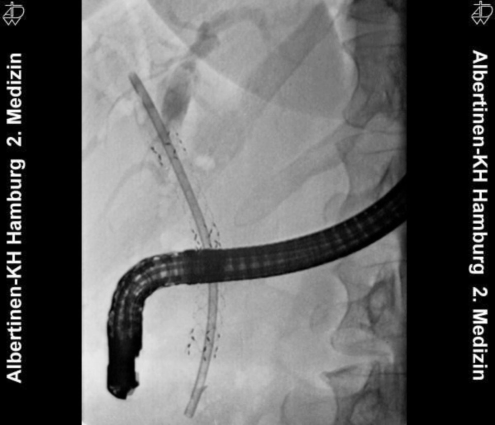 Stent in Stent