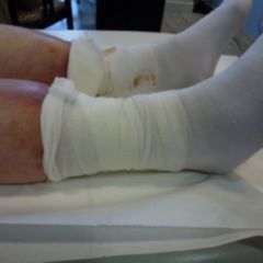 Pyoderma gangraenosum - DocCheck Flexikon