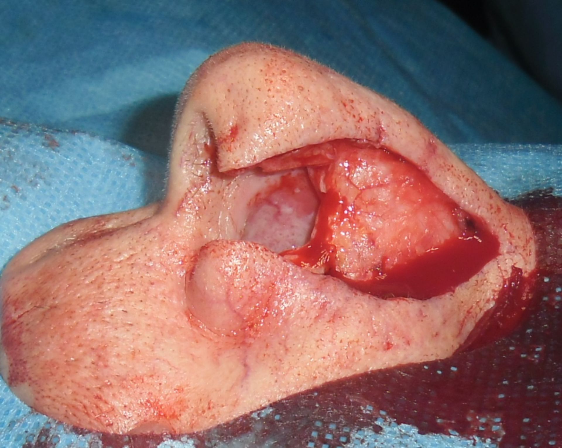 Carcinoma basocelular - intraoperativo después de la segmentotectomía