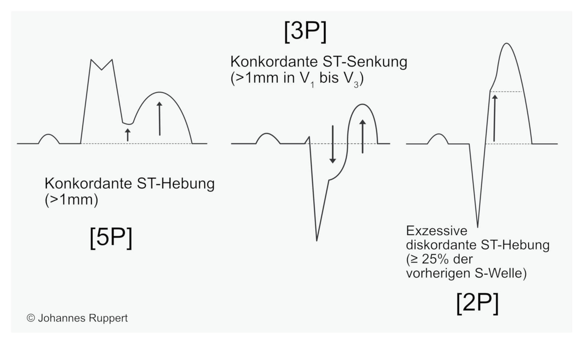 Modifizierte Sgarbossa Kriterien