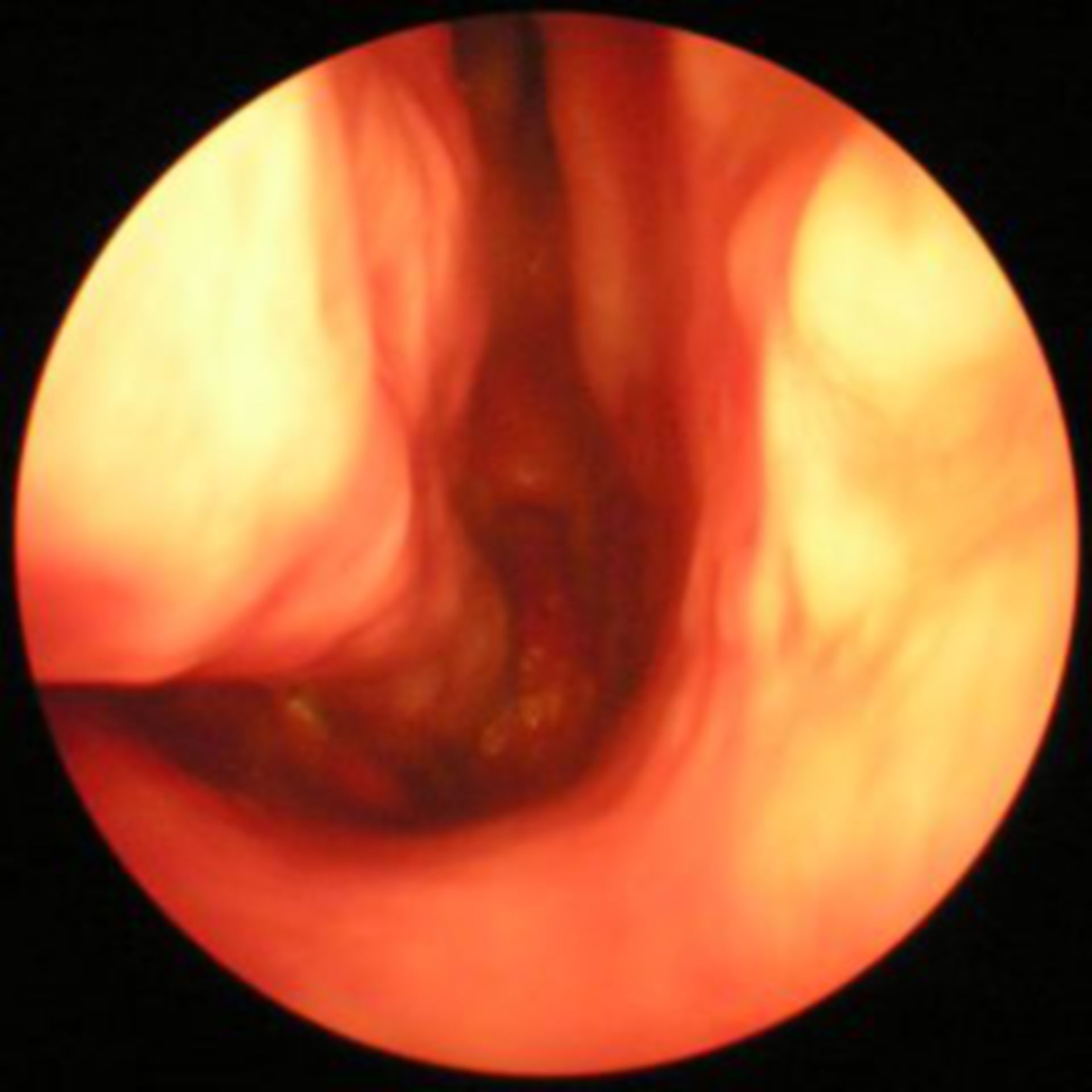 Nasal meatus