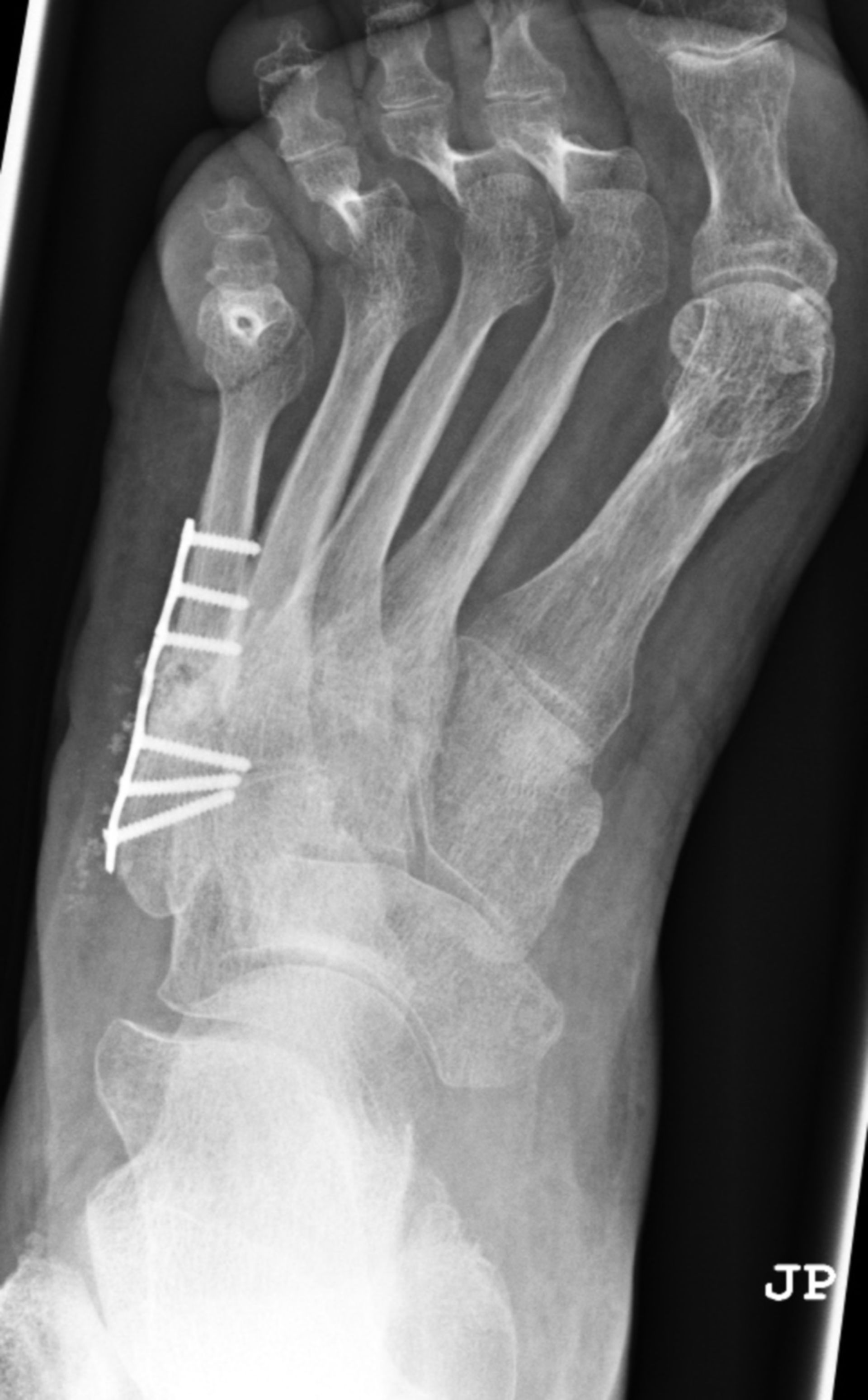 Metatarsal fracture – plate osteosynthesis