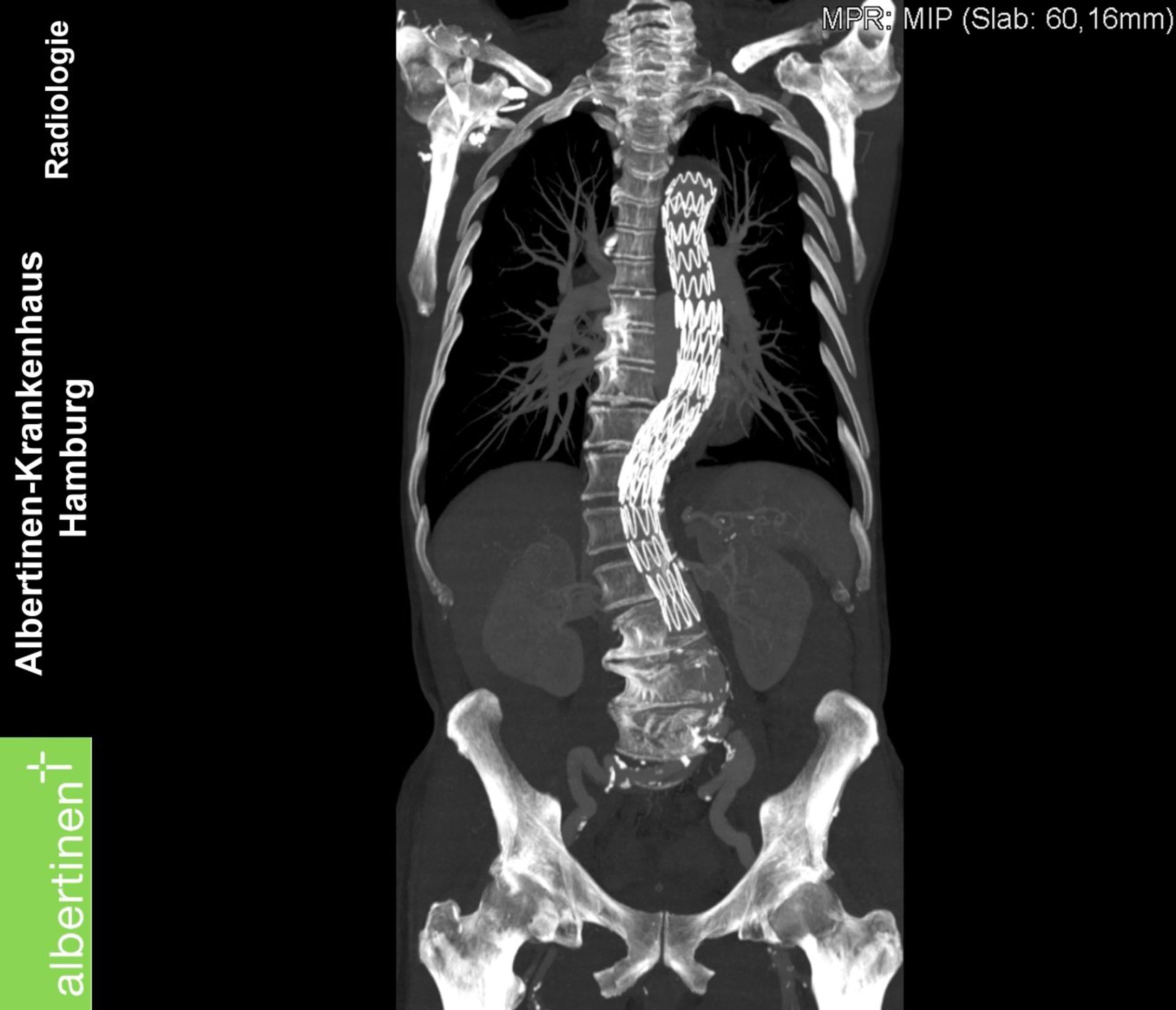 CT Aortenstent bei Dissektion längs