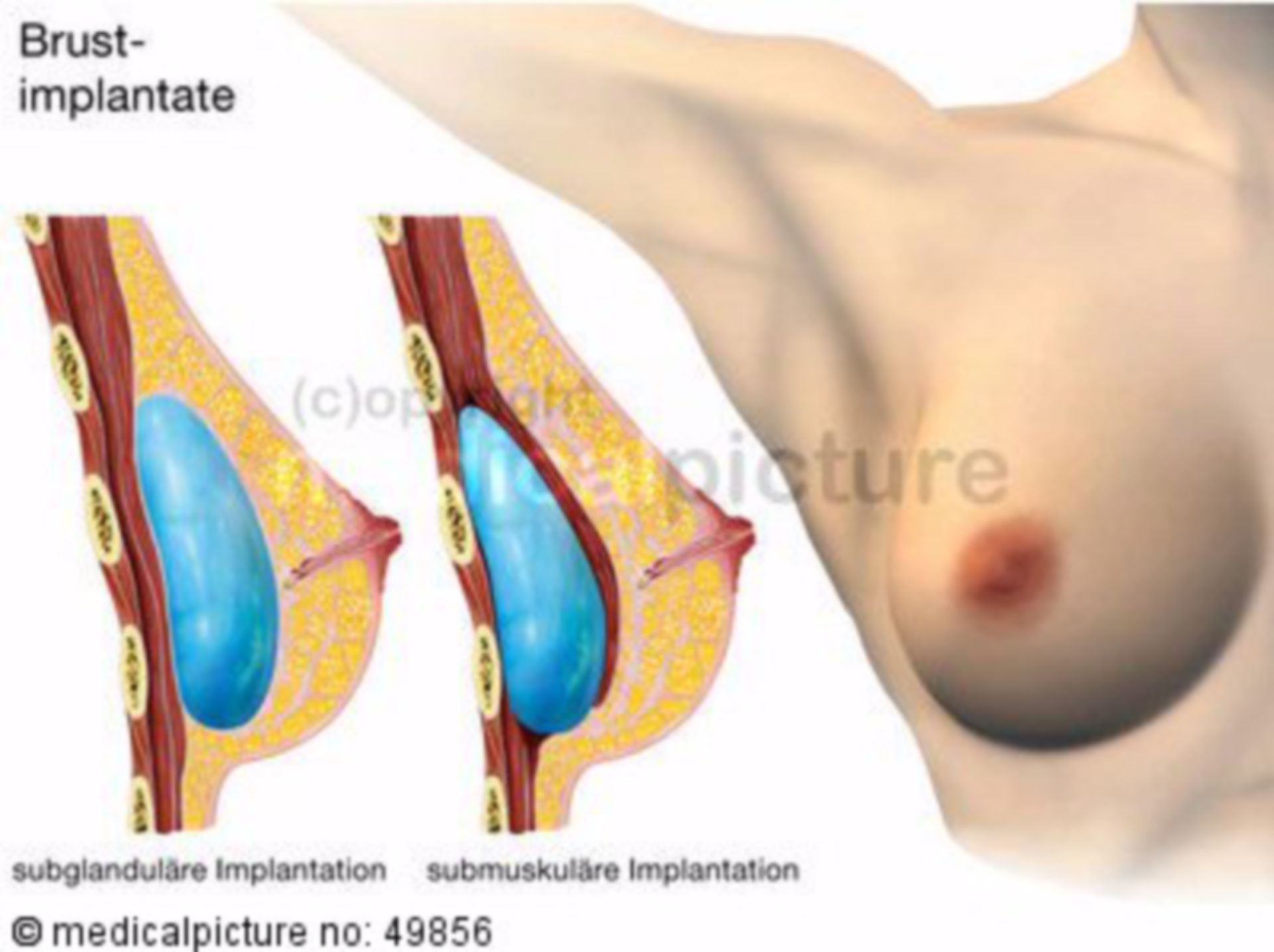 Breast implant/augmentation (labelled)