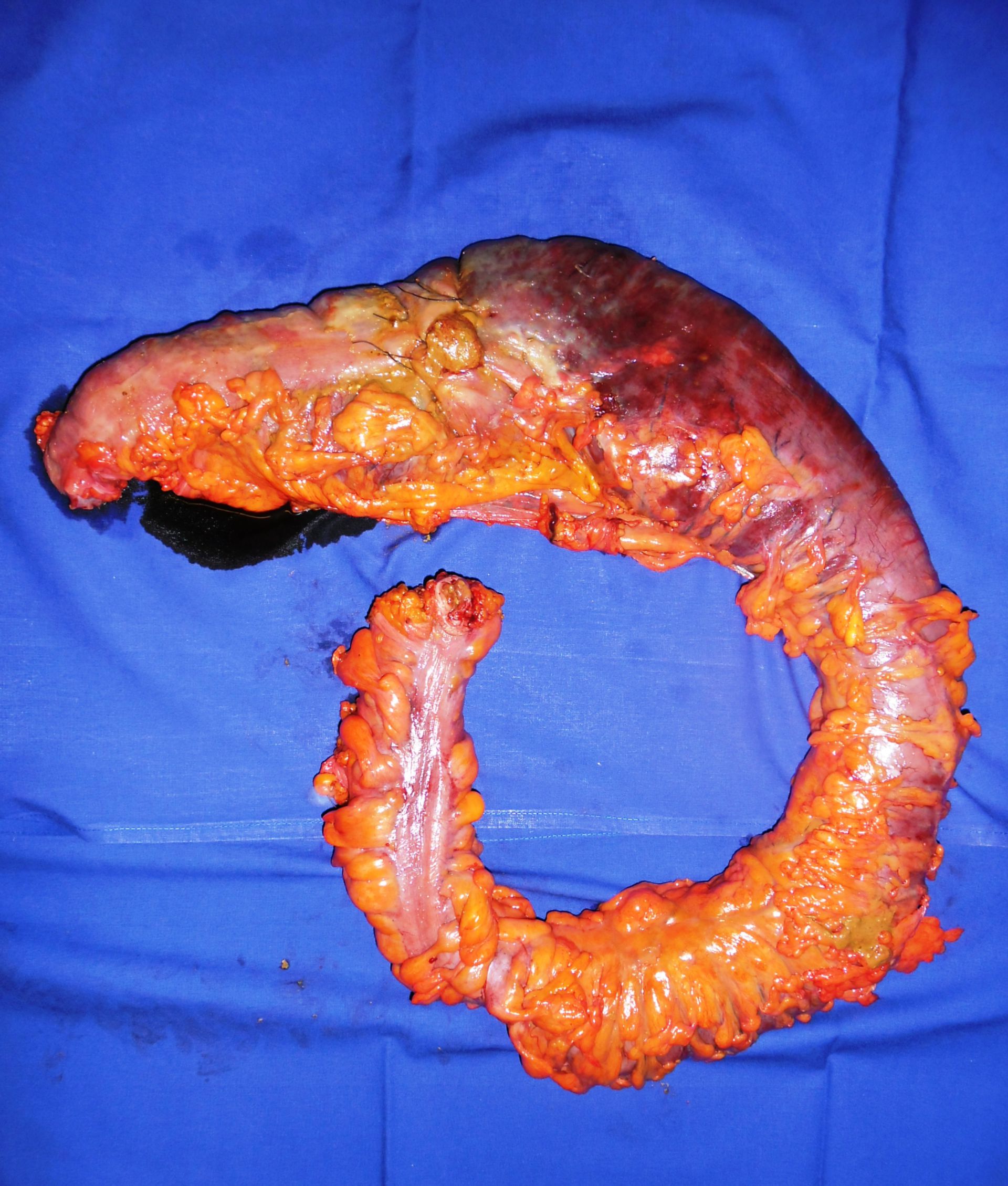 Dickdarmperforation bei M.Crohn - Resektat