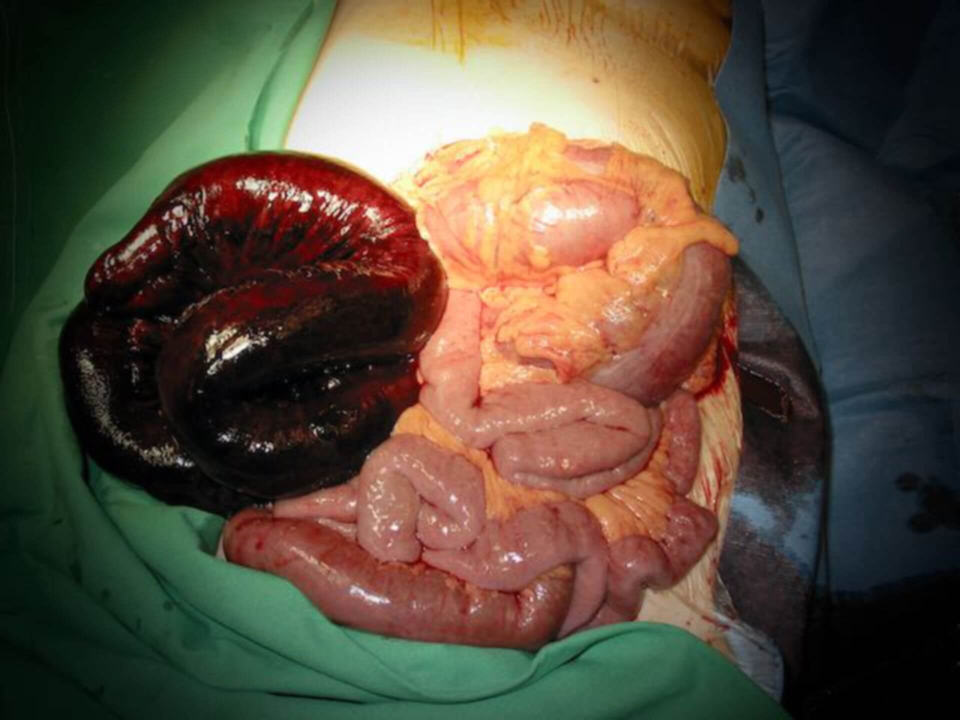 Mesenterialinfarkt