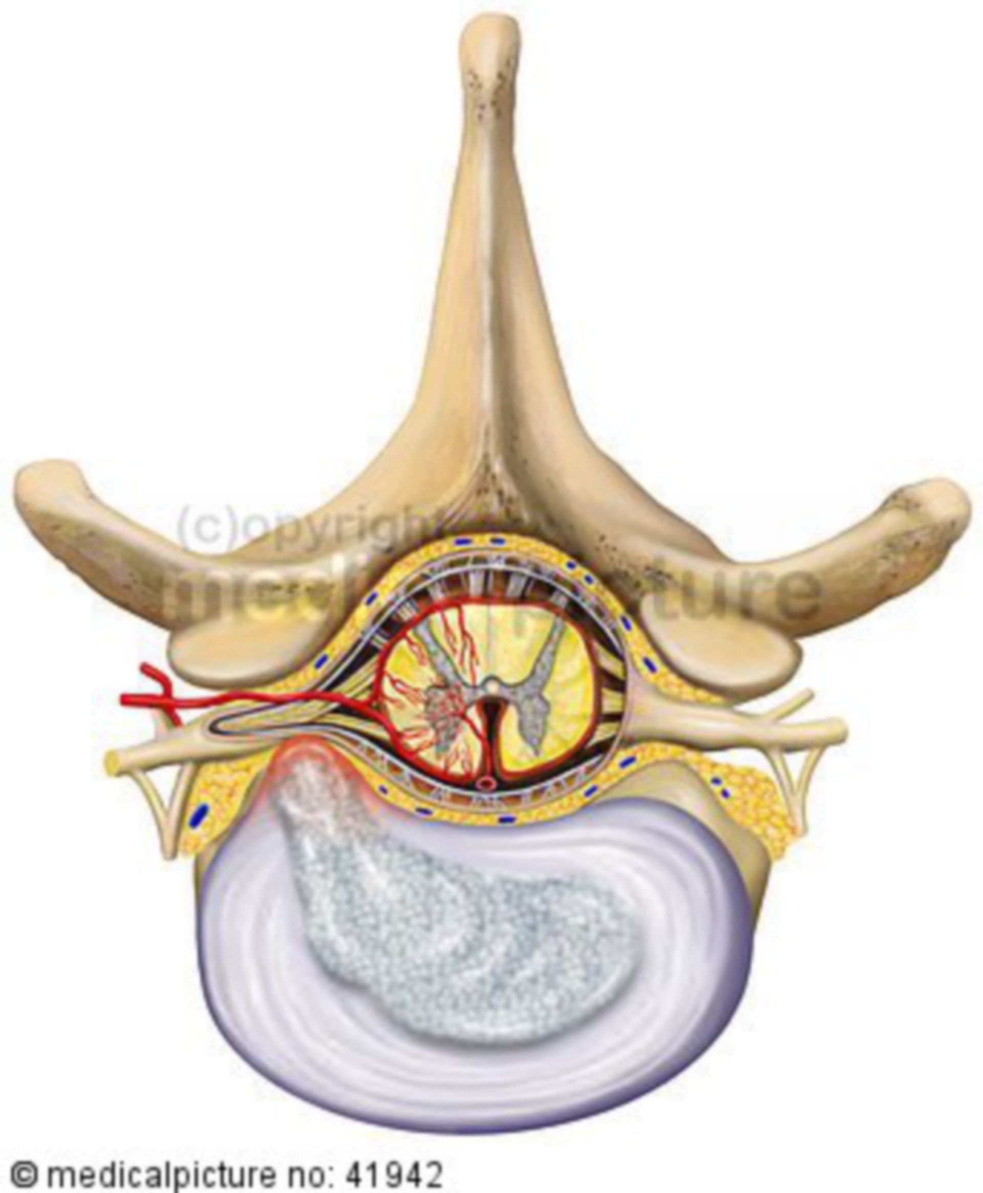 Bandscheibenvorfall, Prolaps, herniated vertebral disc