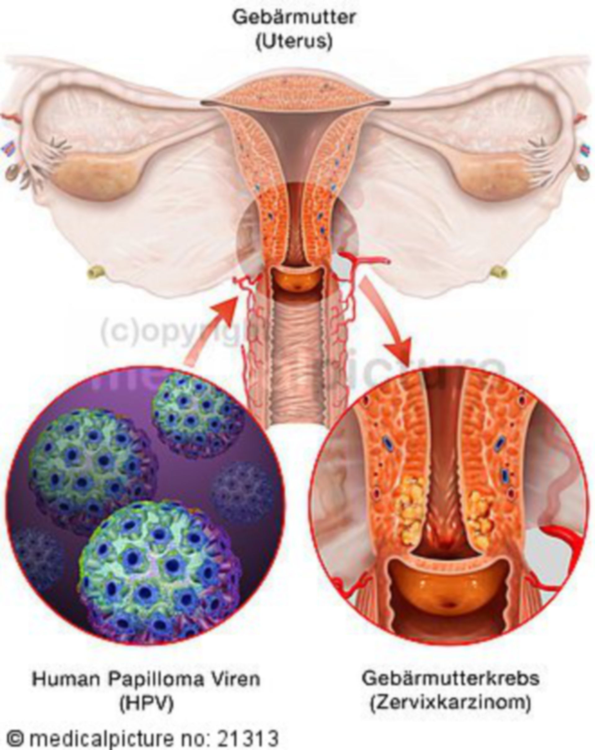 Uterine carcinoma