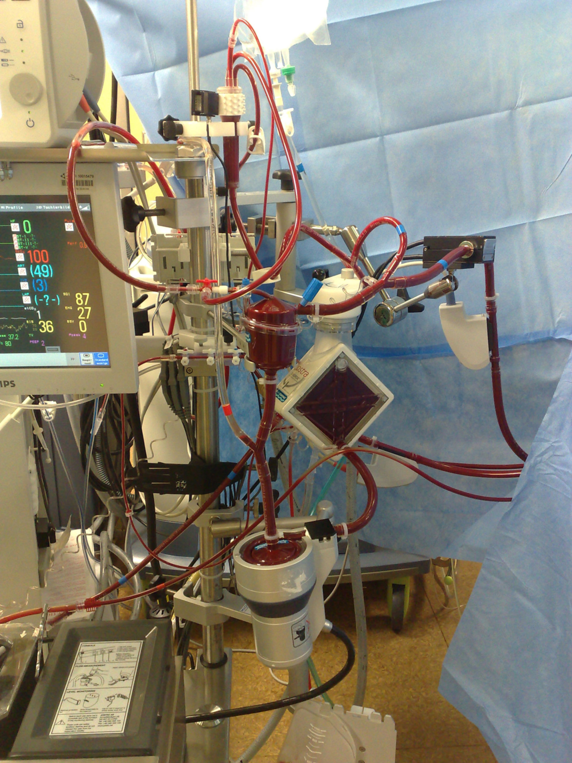 Heart-lung-machine / Cardiopulmonary bypass (2010)