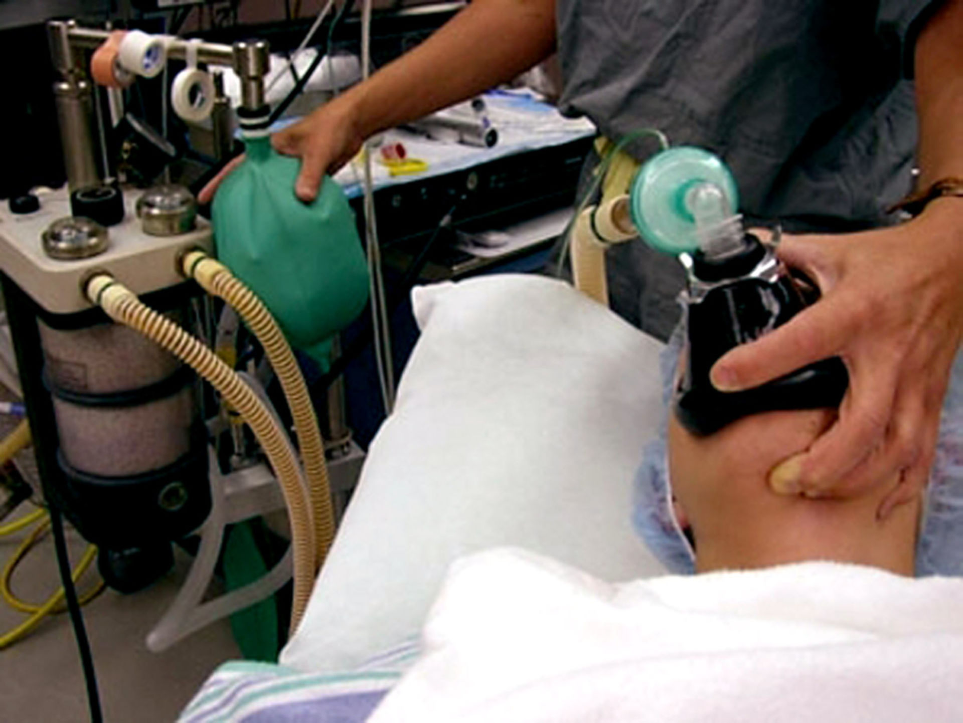Bag valve mask ventilation in anesthesia induction