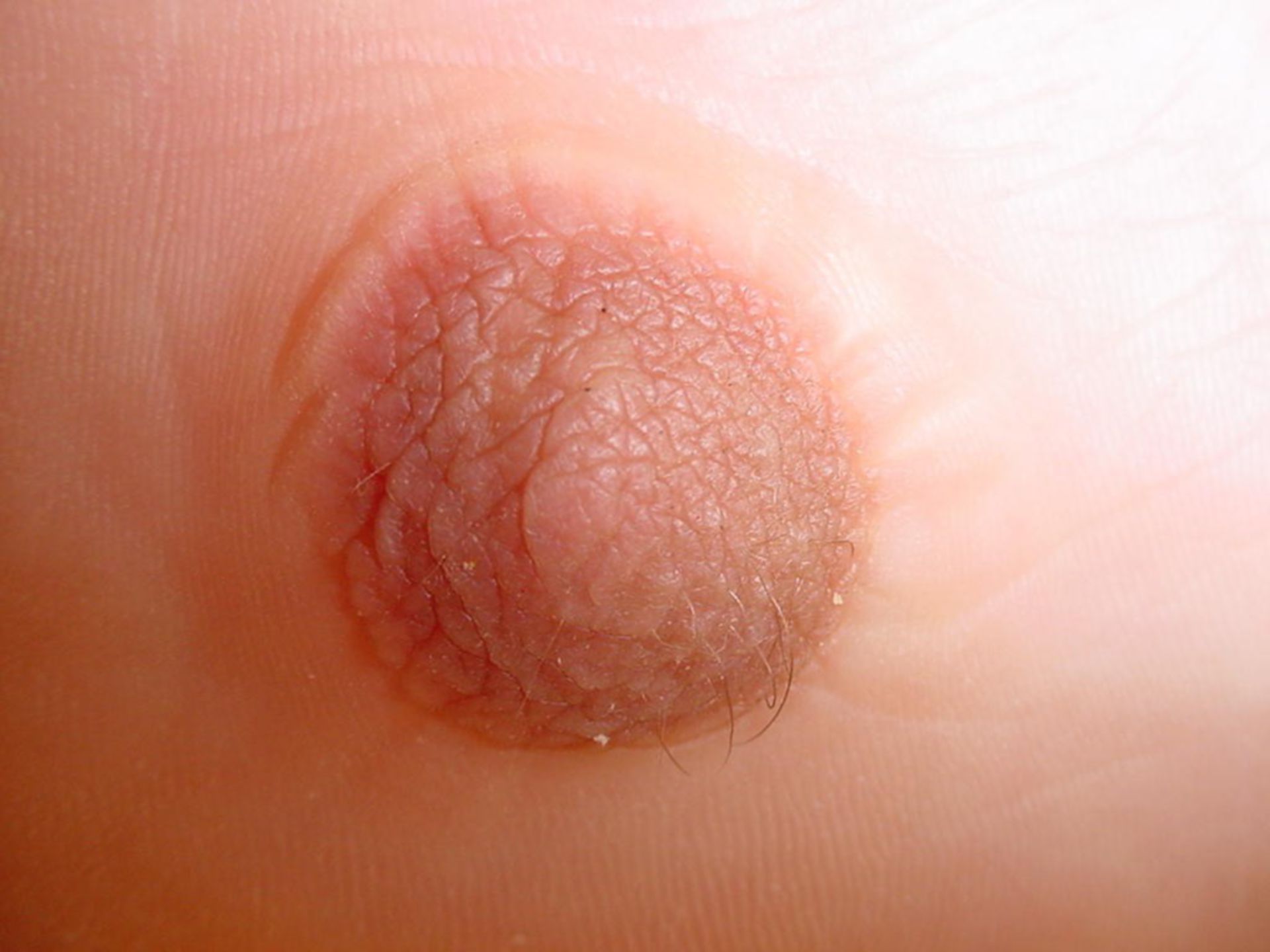 Pseudomamma der Fußsohle: Aberrantes Brustgewebe (Detailansicht)