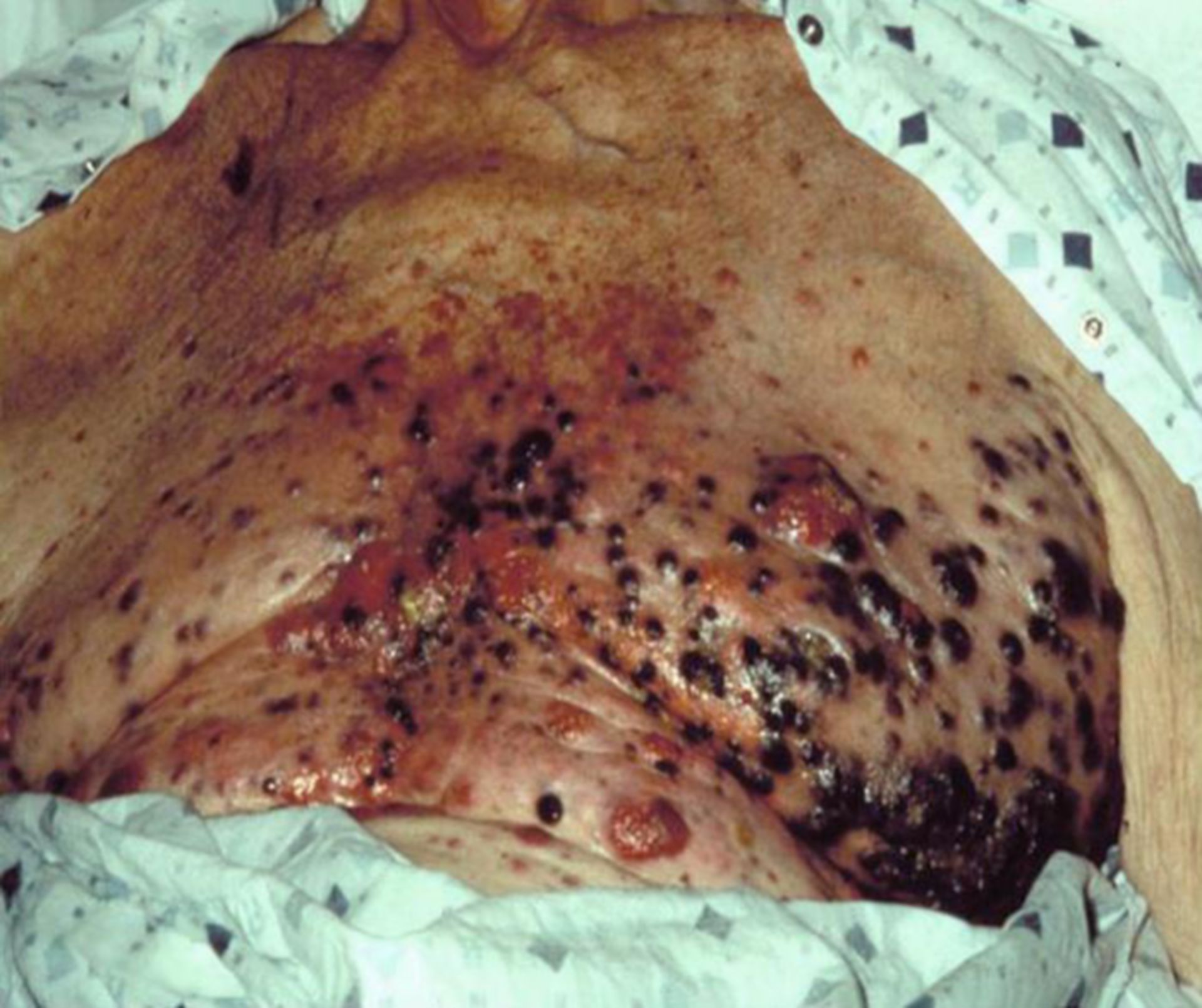 Extensive malignant melanoma on a patient's chest
