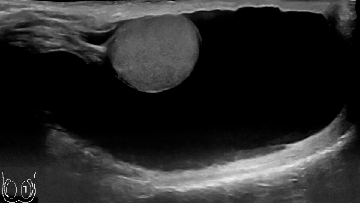 Hydrozele testis