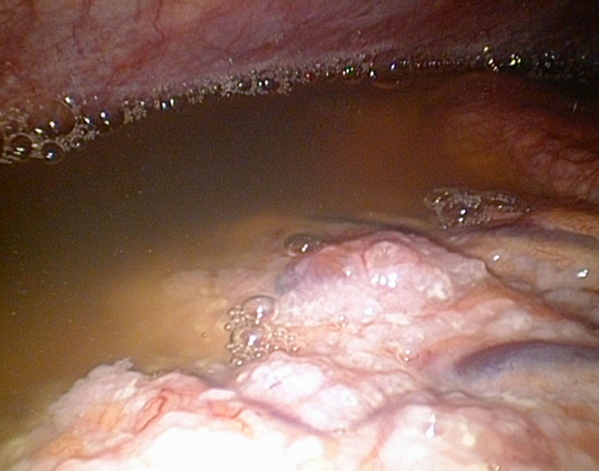 Ascites bei Peritonealcarcinose (OvarialCa)