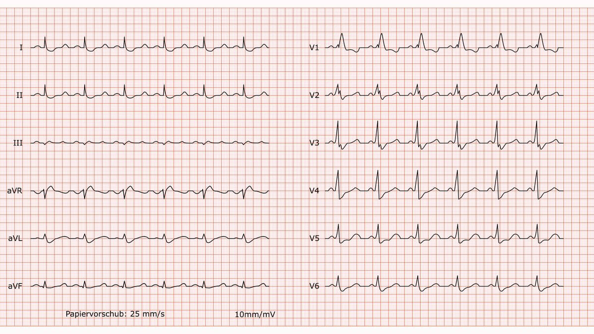 12-Kanal-EKG bei komplettem Rechtsschenkelblock