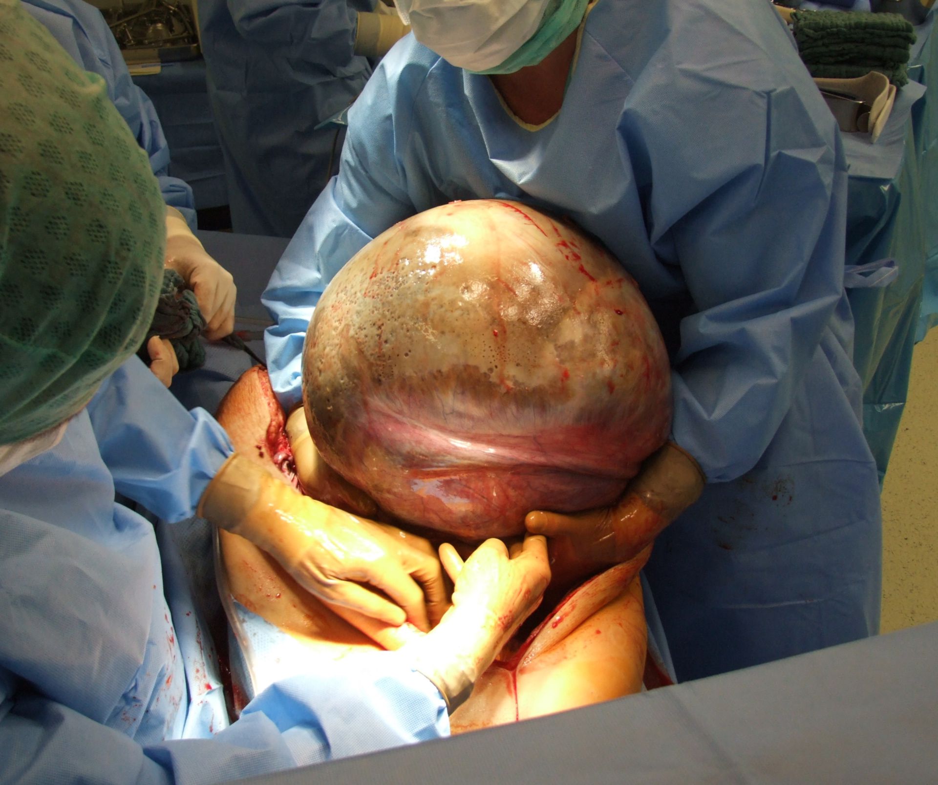 Ovarial Tumor