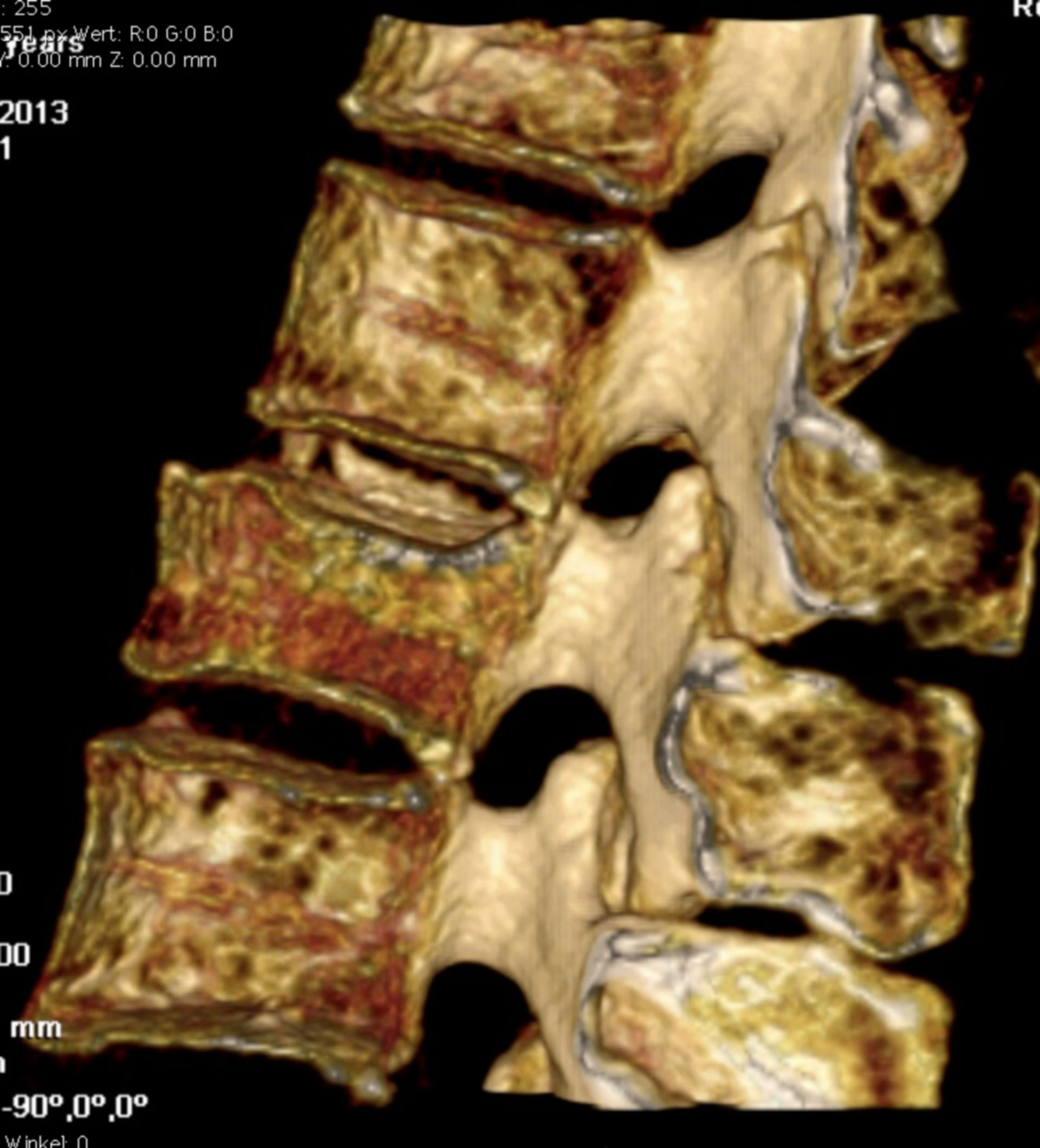 3D-Rekonstruktion einer CT der LWS mit LWK-1-Berstungsfraktur (7/8)