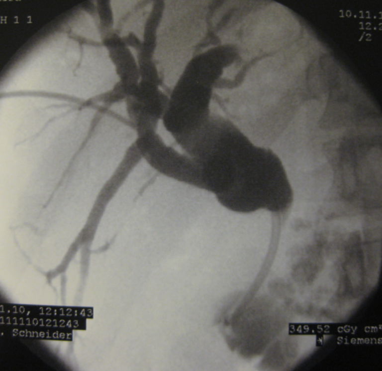 Pthc PTHC – Calcifying Papillitis with Chronic Pancreatitis - DocCheck