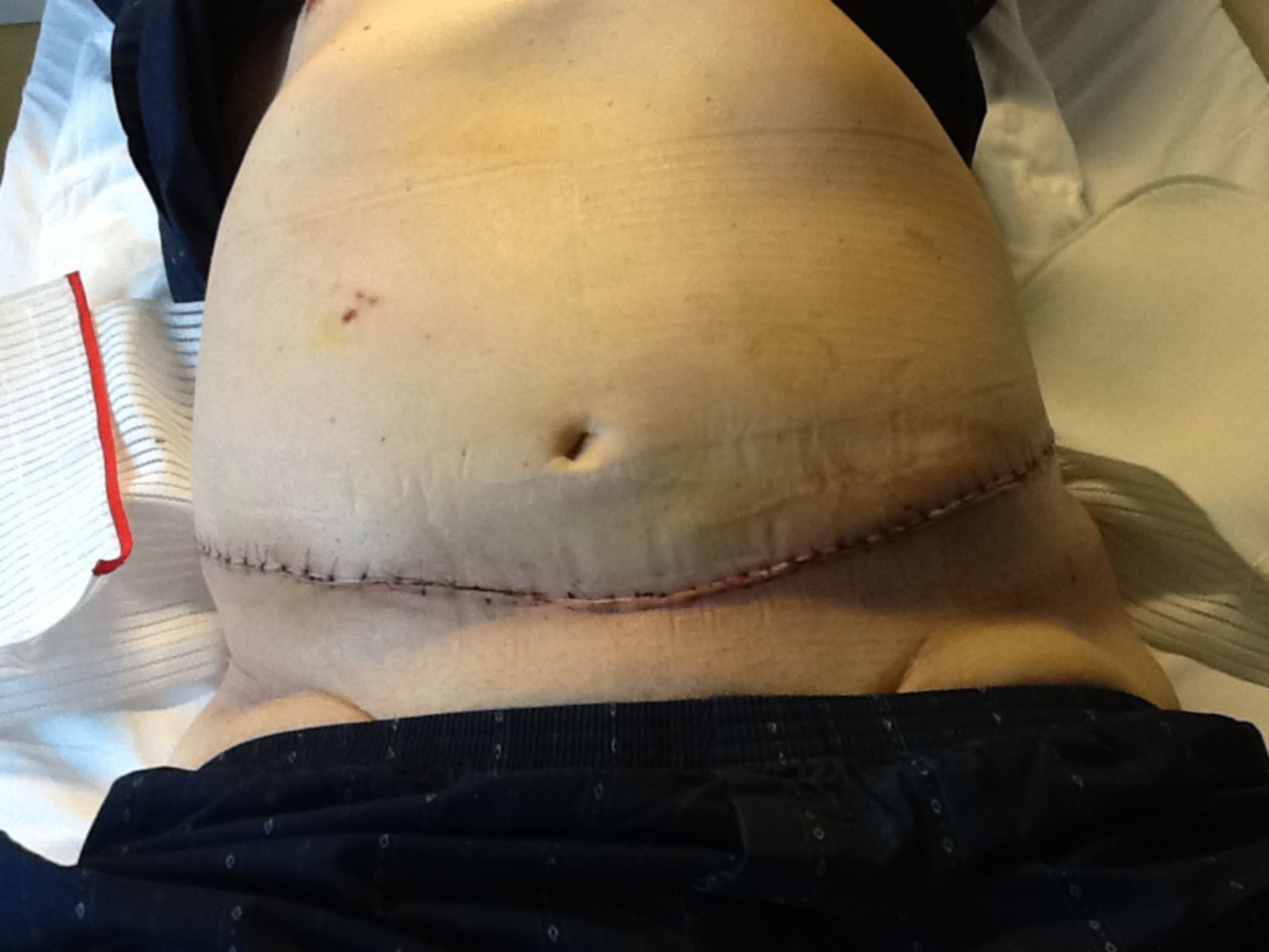 Patient after resection of a fatty apron