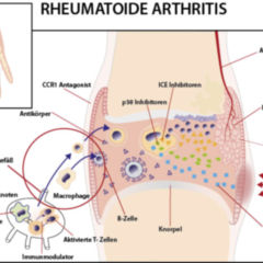 reaktív rheumatoid arthritis)