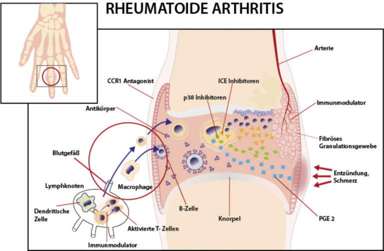 rheumatoide arthritis doccheck