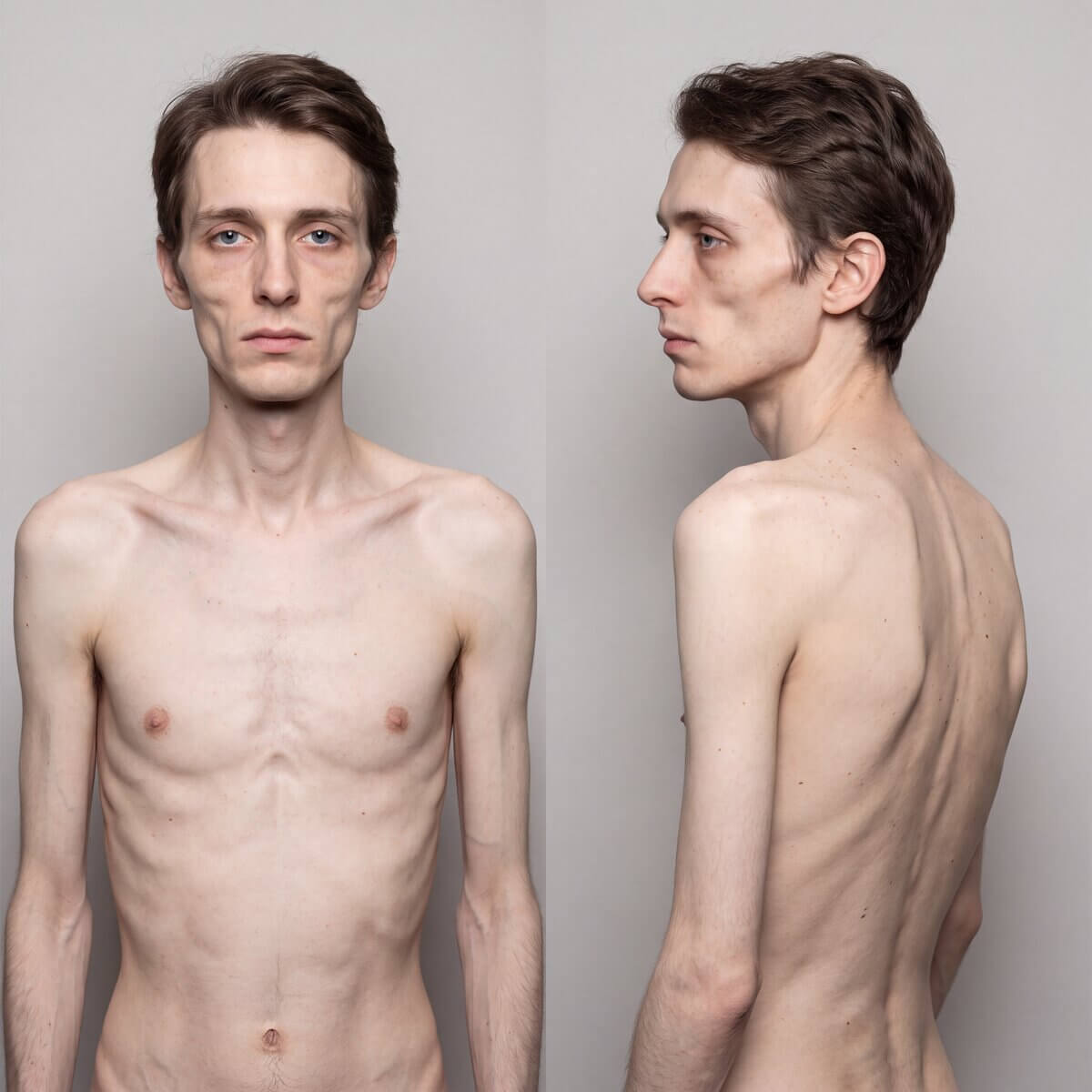 Mann mit Anorexia nervosa