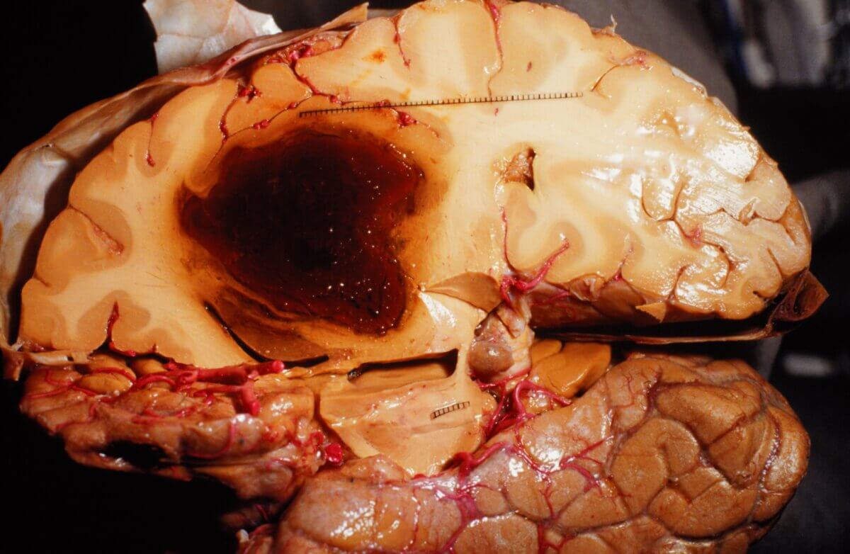 Intrazerebrale Blutung