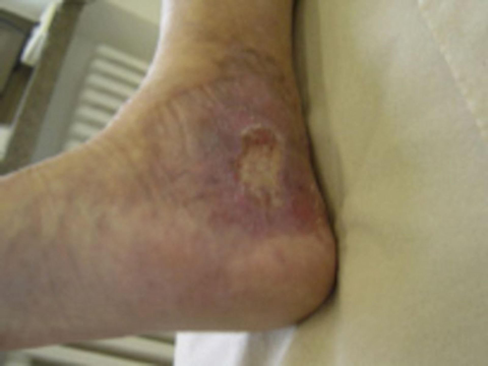 Offenes Bein nach mehrmaligen Frakturen (1)
