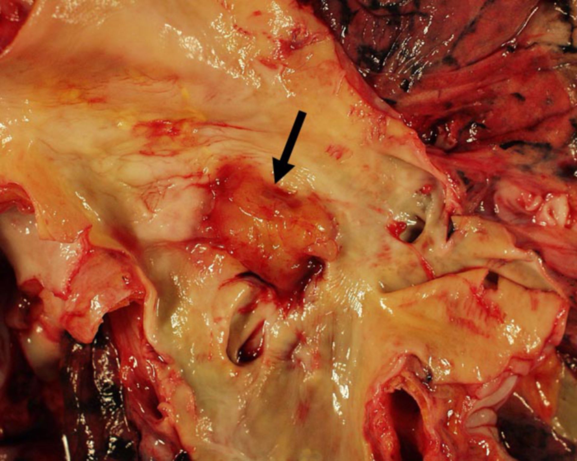 Pulmorary embolism