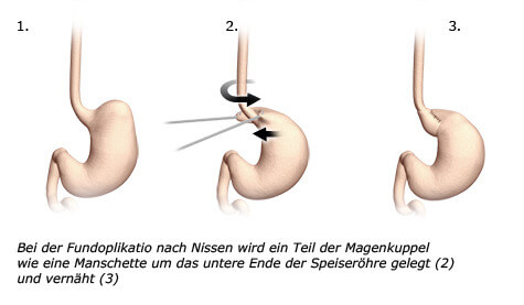de_magen-op4_fundoplikatio_original.jpg