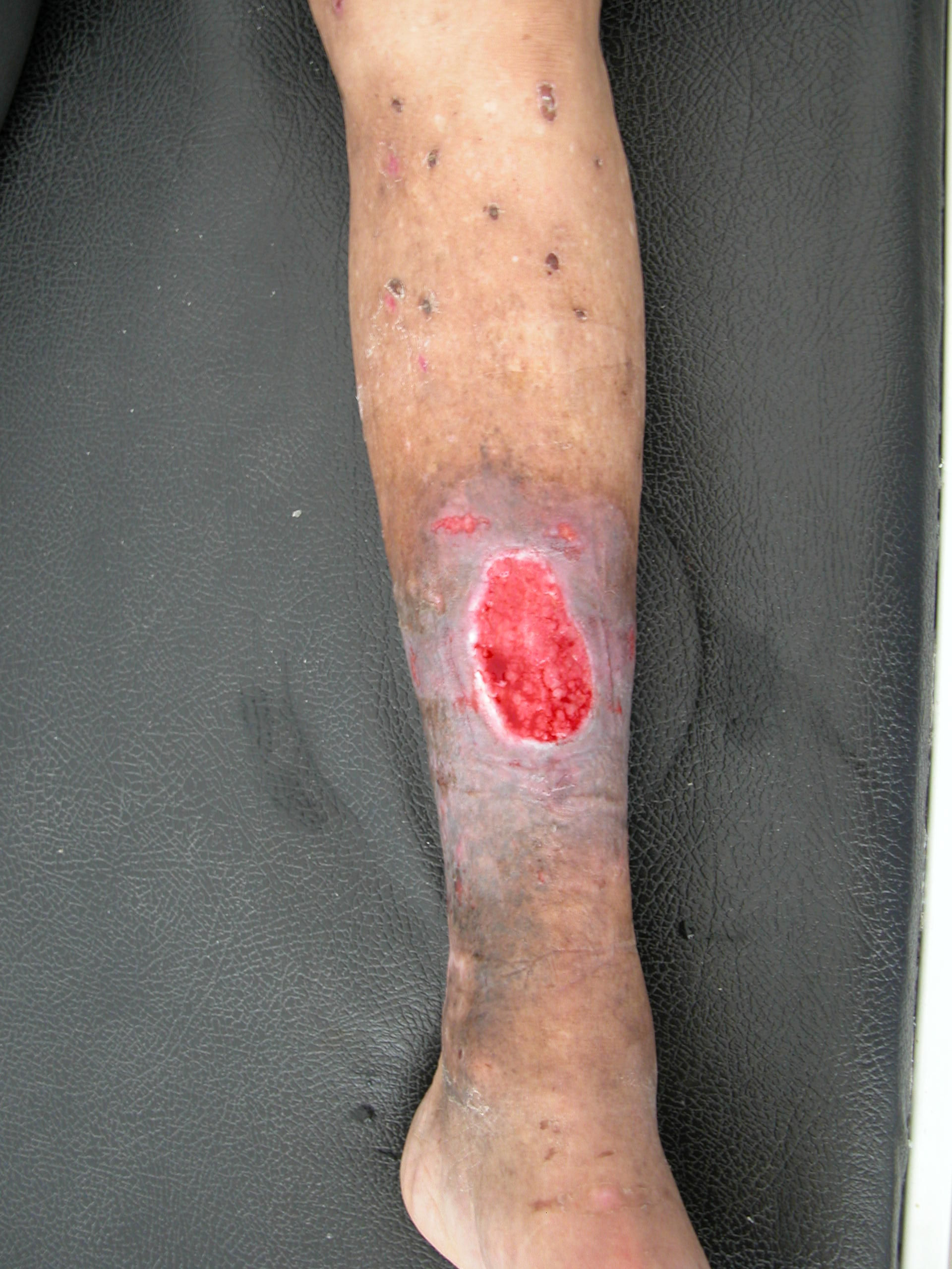 Ulcera della gamba