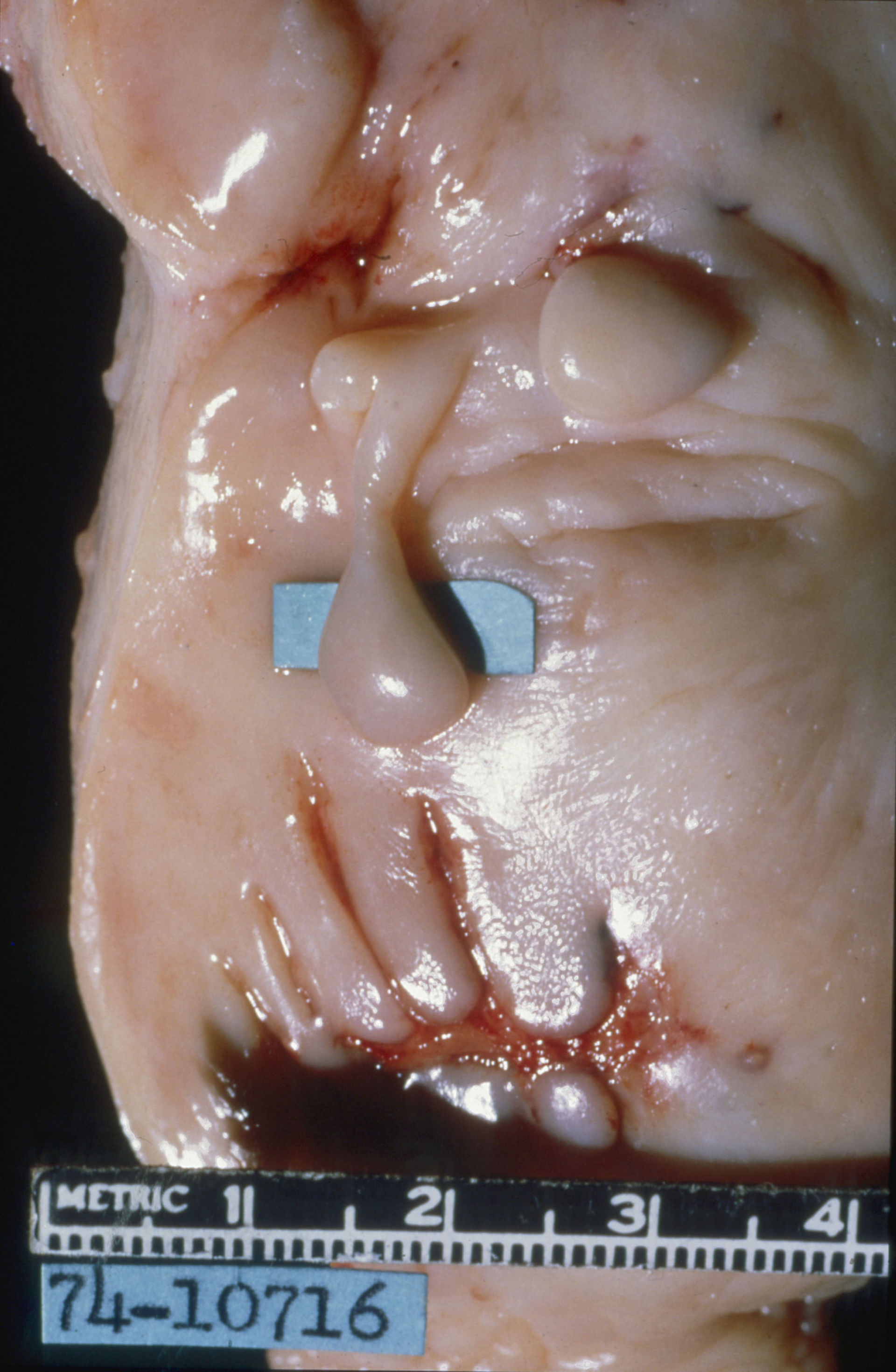Anatomy: Diethylstilbestrol (DES) Cervix