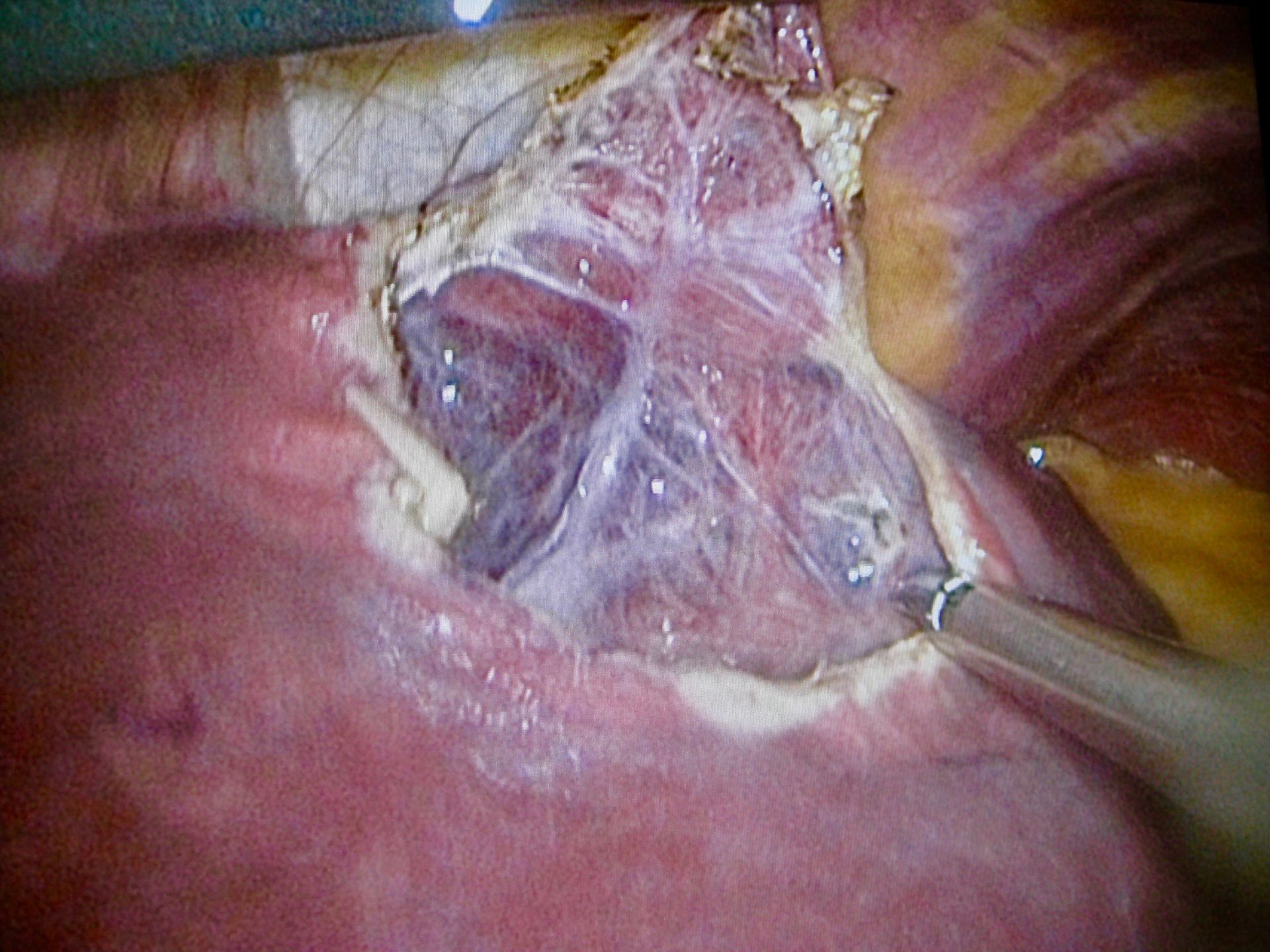 Große Lebercyste-laparoskopisch entdacht