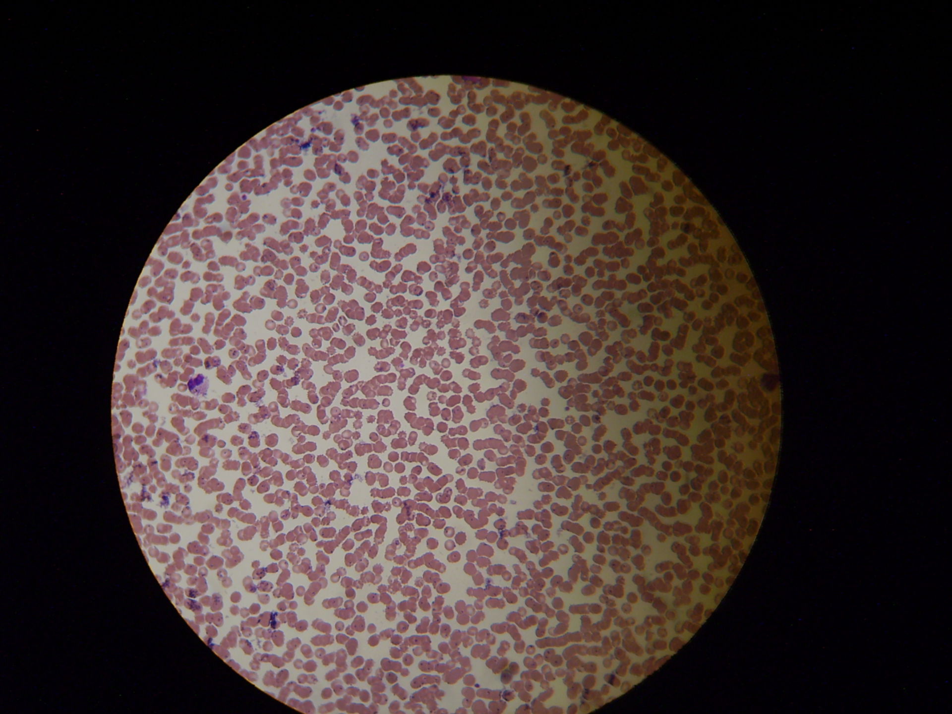 Malaria da Plasmodium falciparum