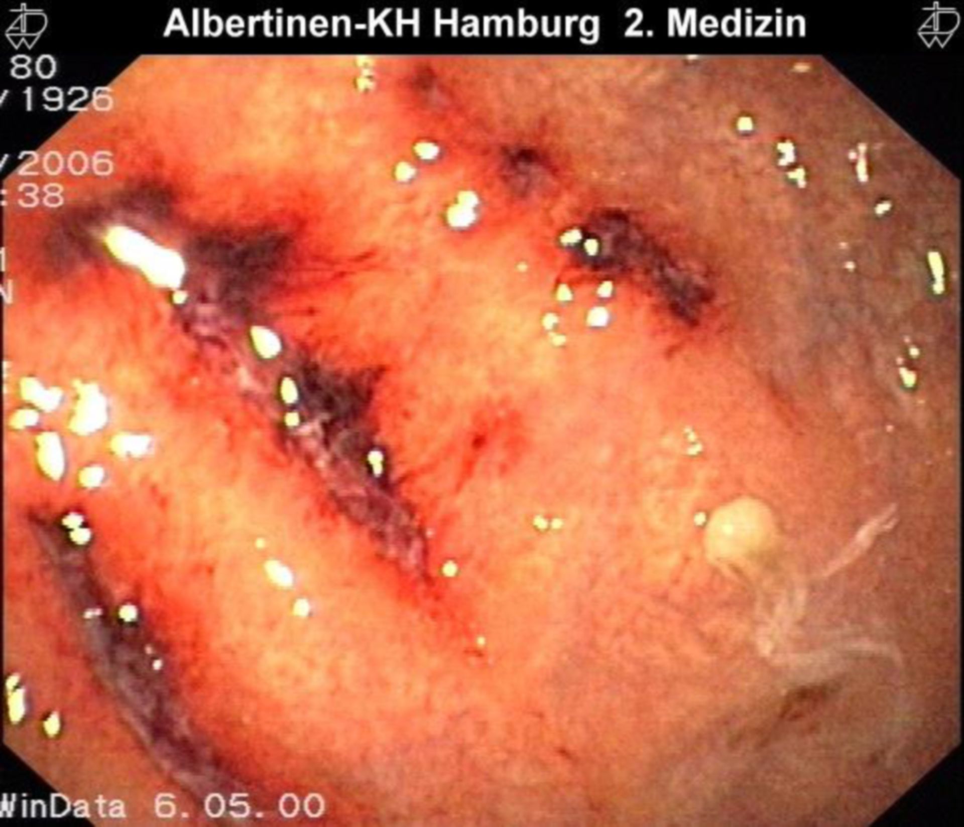 Hemorrhagic gastritis (3)