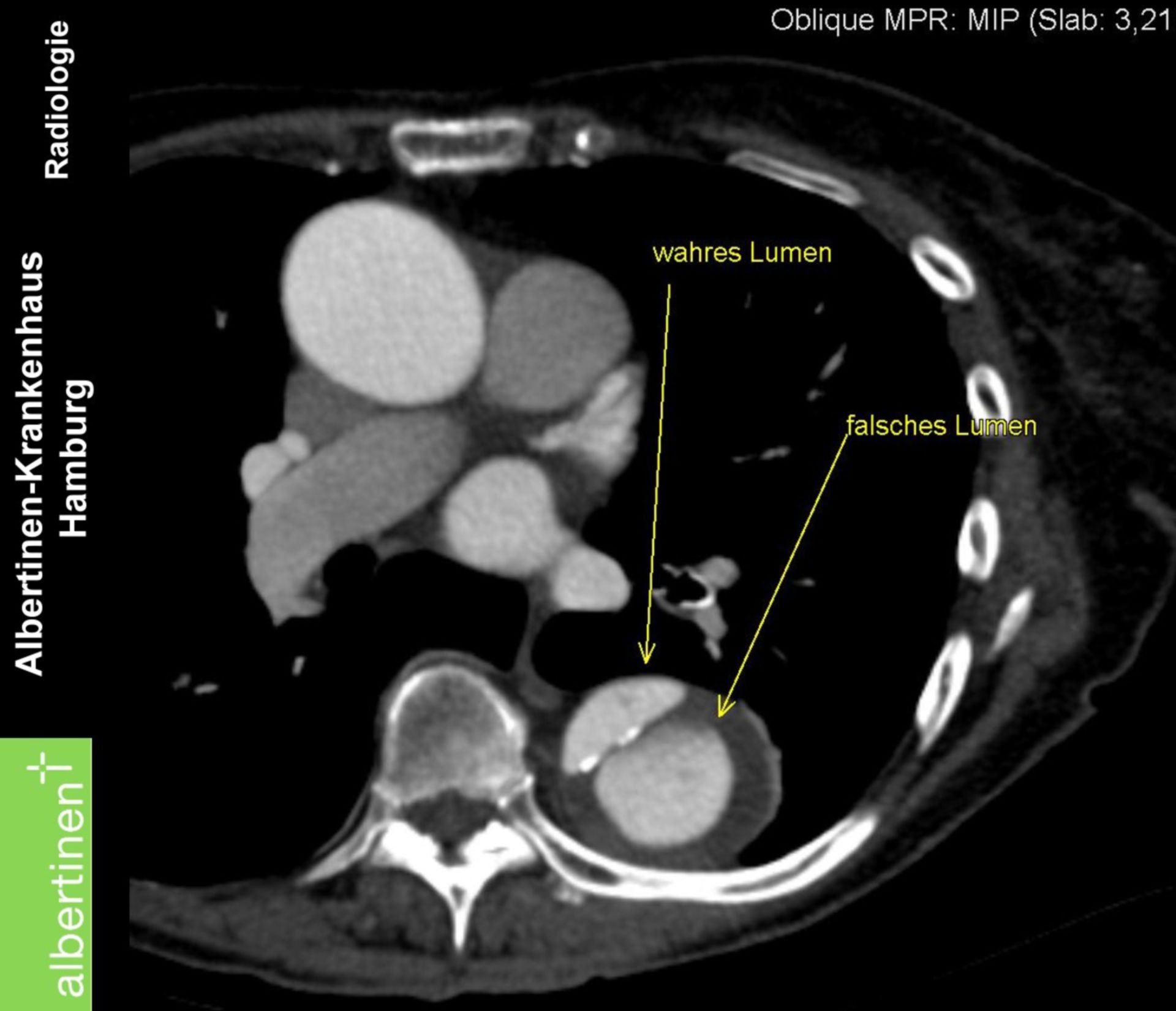 CT: Aortendissektion quer Thorax