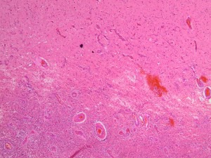 Mikroskopaufnahme eines gefärbten Gewebeschnittes, das den Übergang von Tumorgewebe (unten) zu normalem Gewebe (oben) im Gehirn zeigt