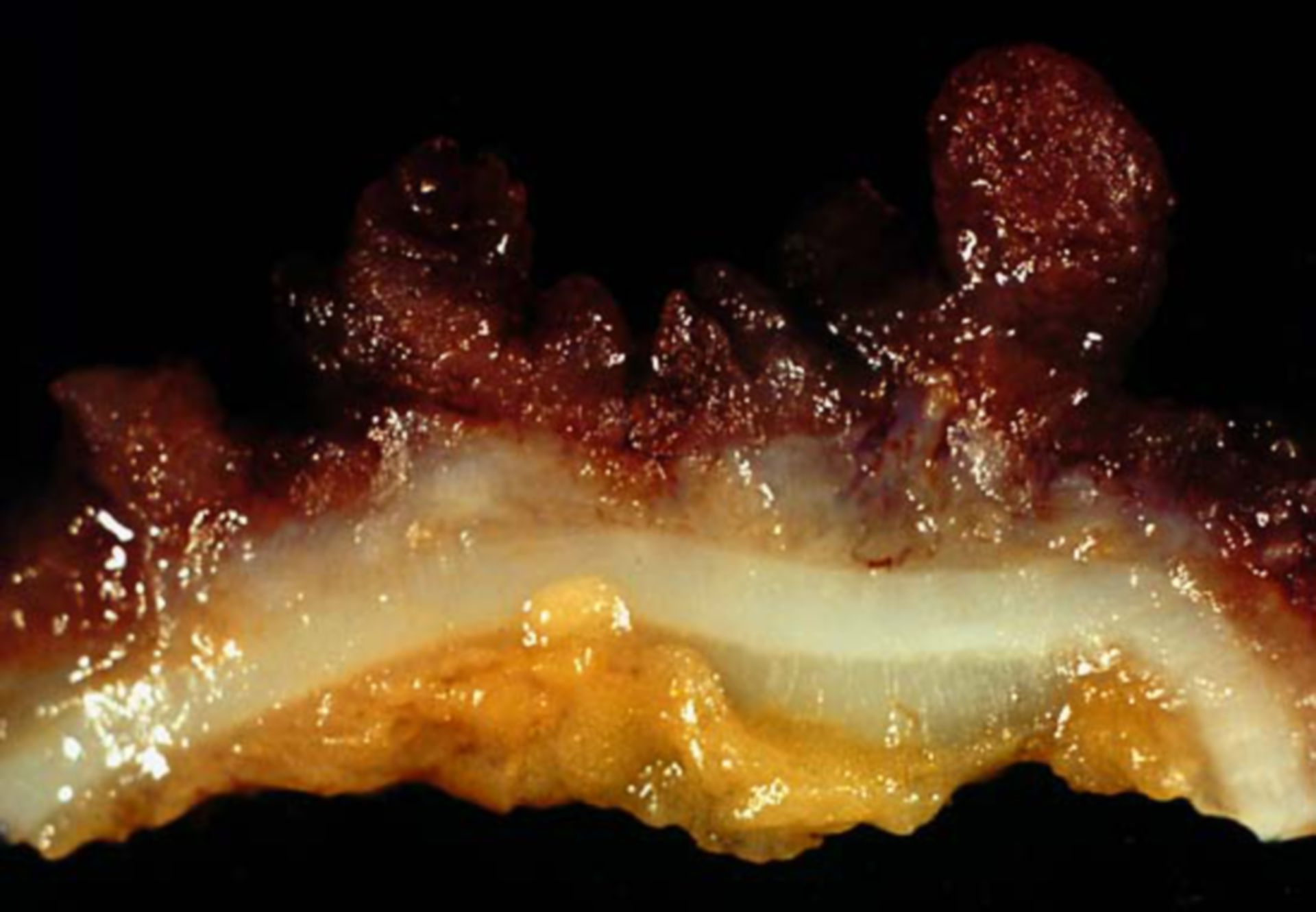 Colitis ulcerosa (3)