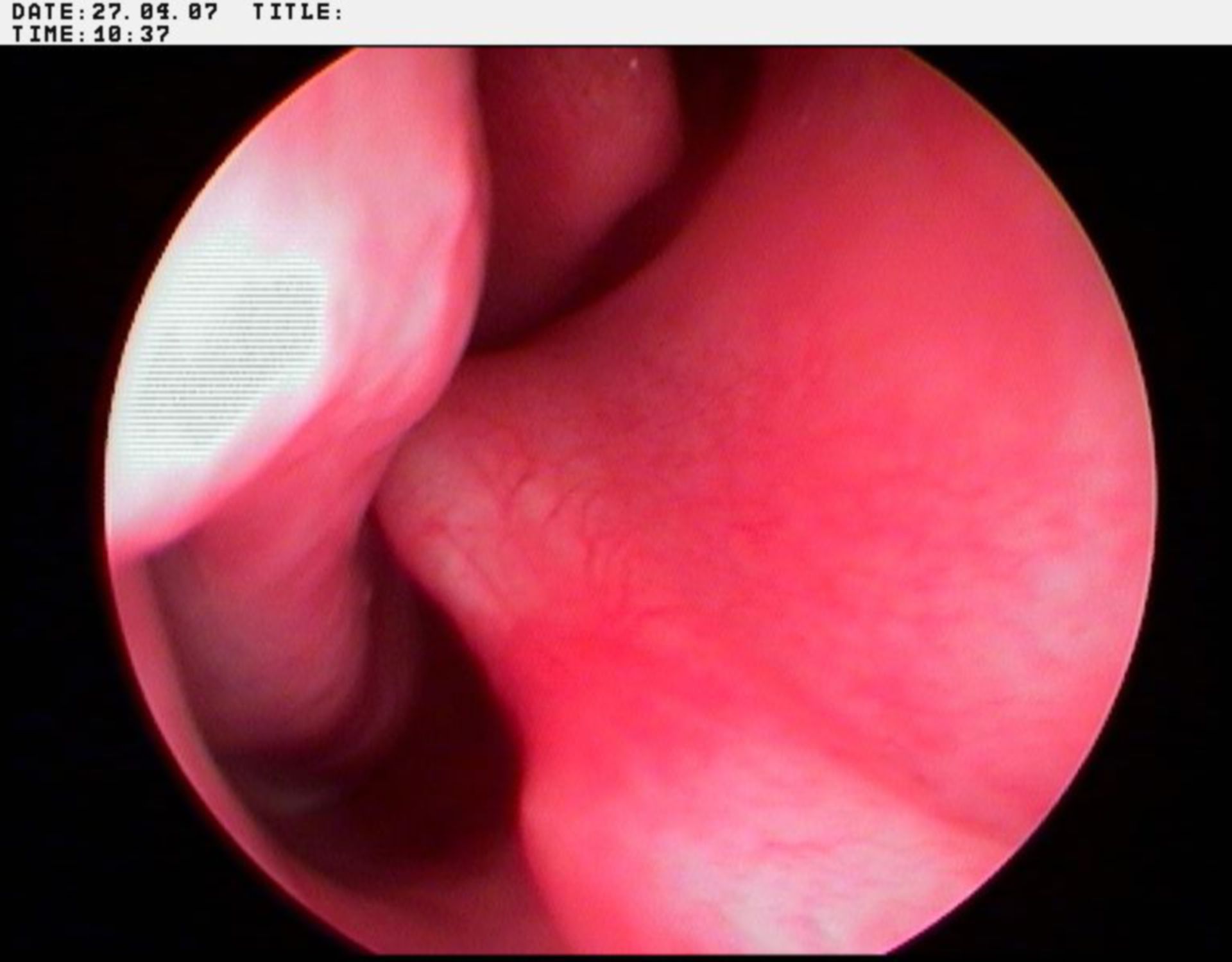Curvature of the nasal septum to the right