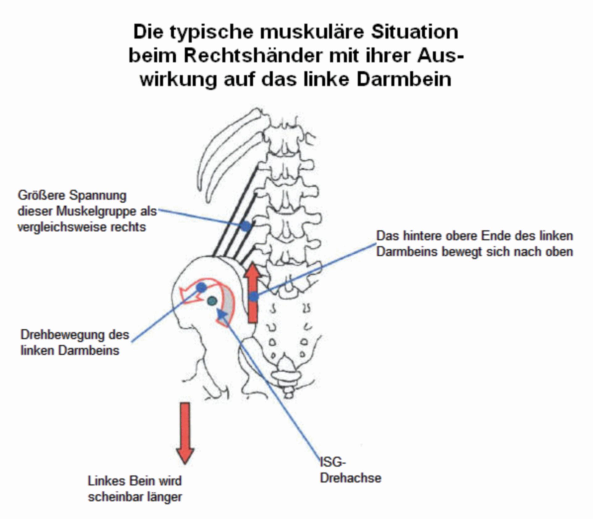 Entstehung einer funktionellen Beinverkürzung