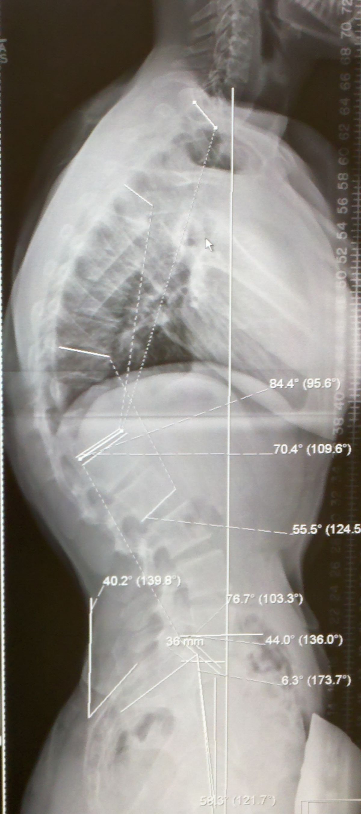 Röntgenaufnahme M. Scheuermann