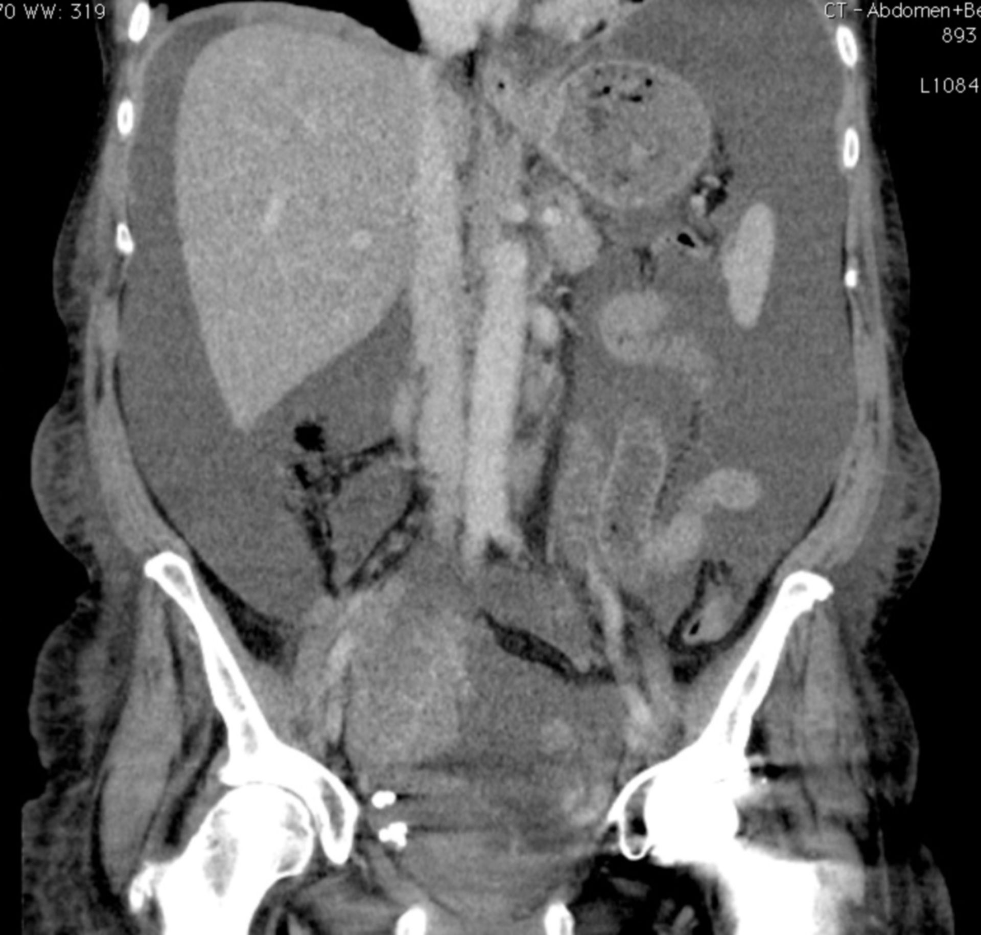 Ascites with suspicion of ovarian cancer