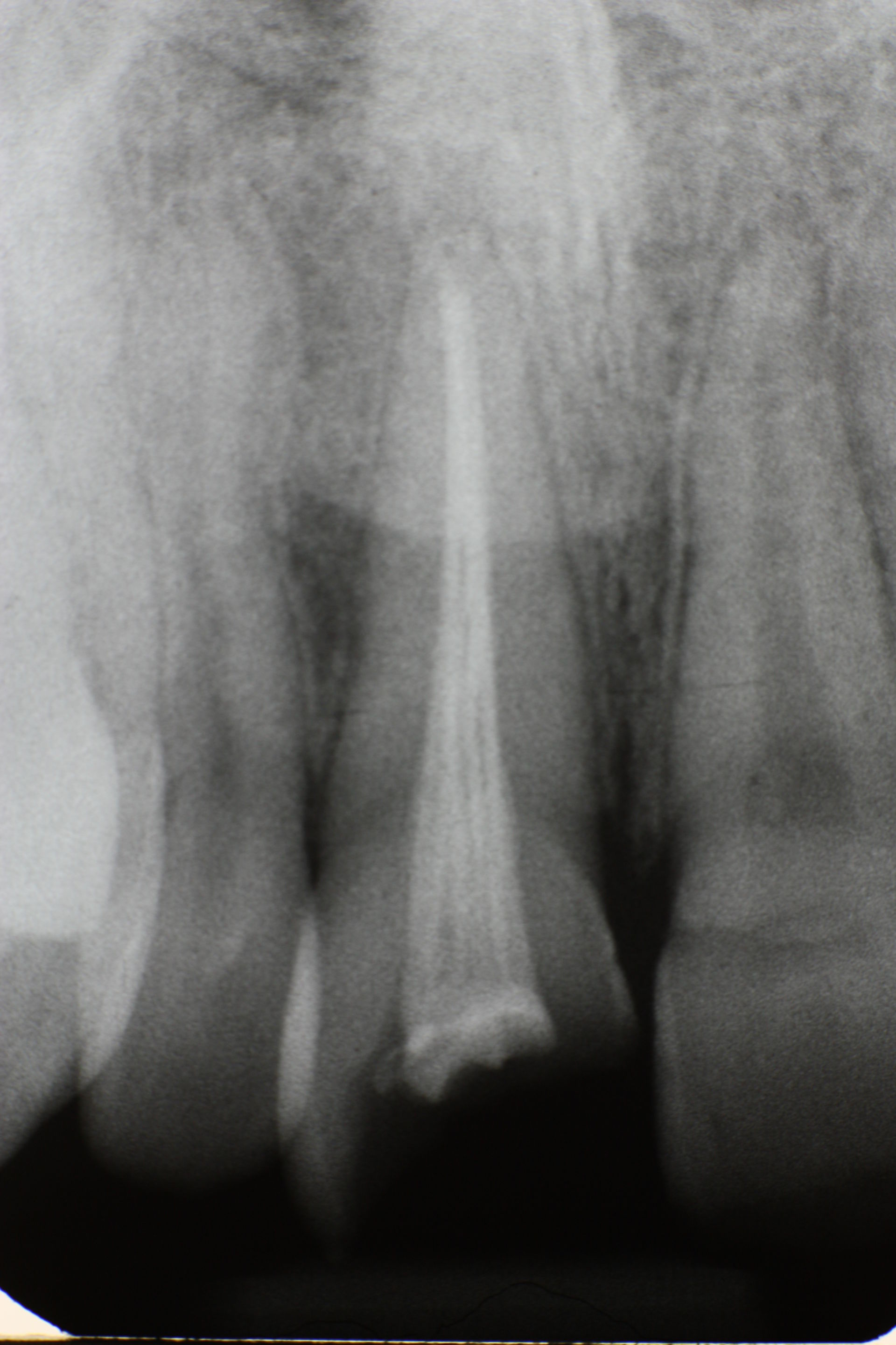 Trauma of the frontal tooth