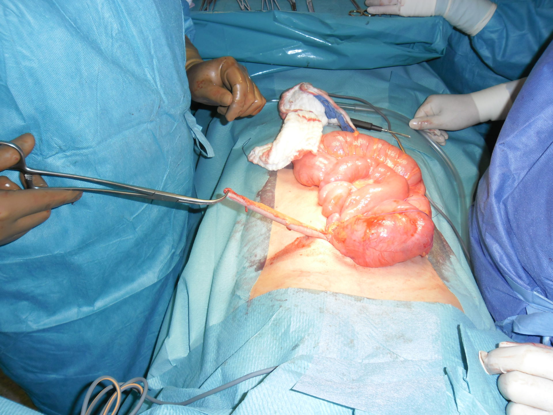 Appendix im linken Oberbauch