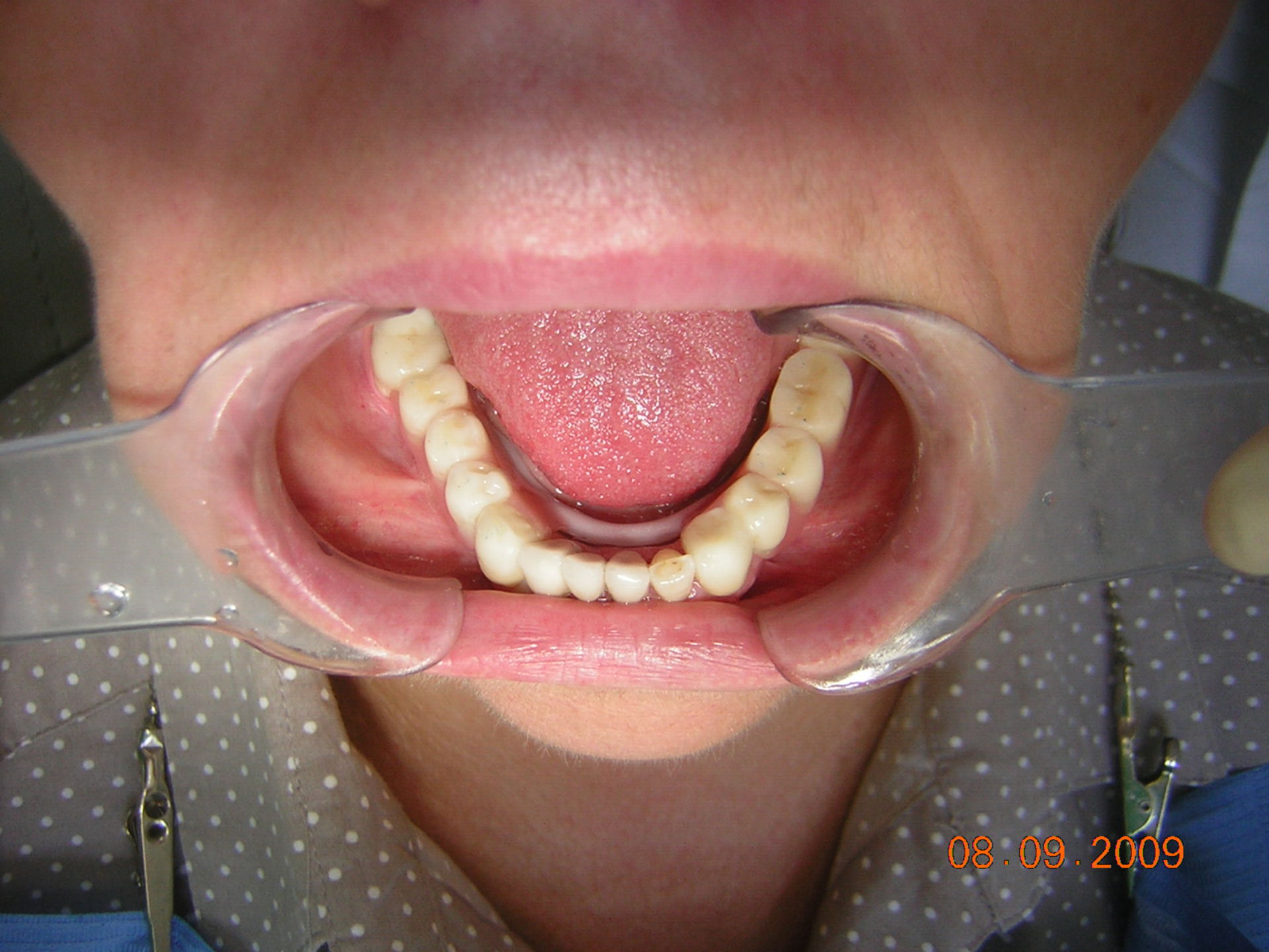 Zustand mit Zahnprothese