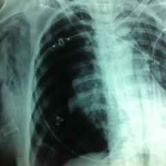 Pneumothorax - DocCheck Flexikon