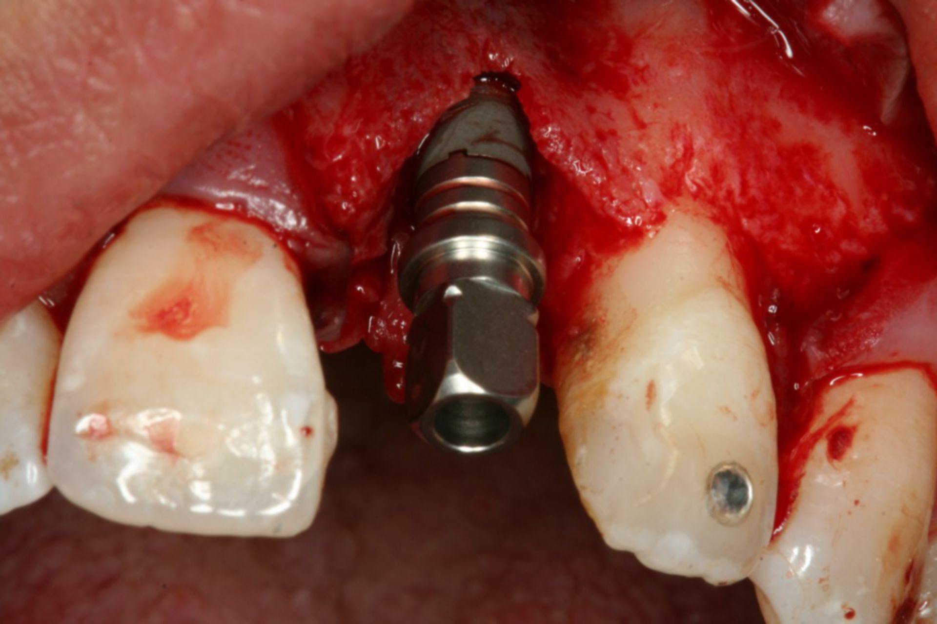 Schraubenimplantat